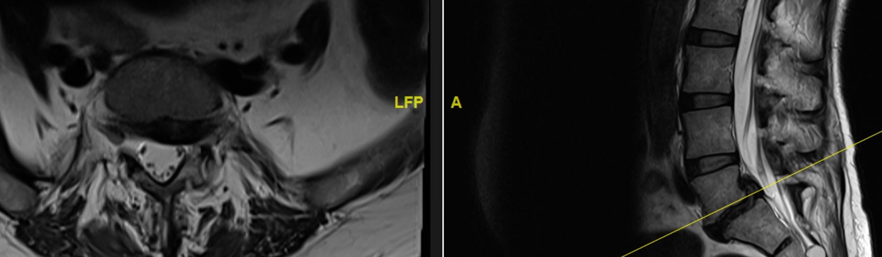 ALIF and Sequestrectomy